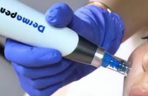 Helpt microneedling tegen rimpels? Resultaten, voordelen en alles wat je moet weten