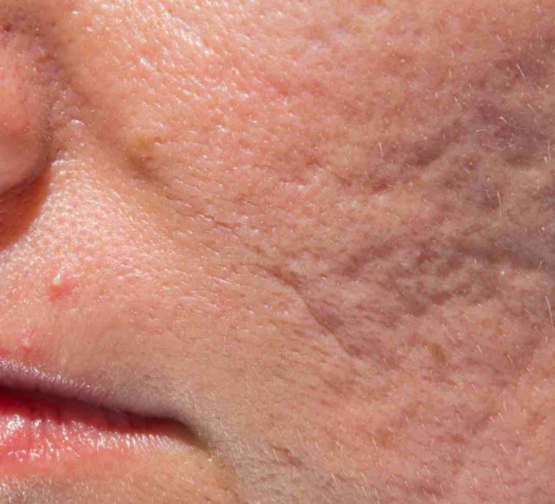 Acne littekens