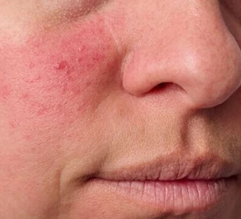 Rosacea