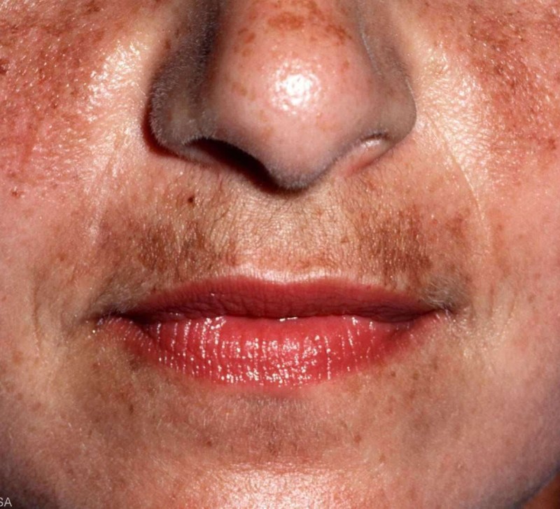Zwangerschapsmasker/melasma